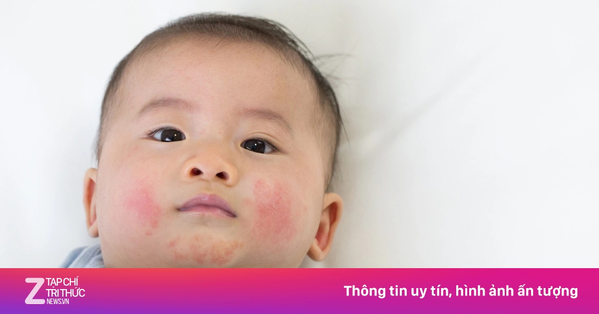 Dấu hiệu cảnh báo trẻ bị viêm da cơ địa