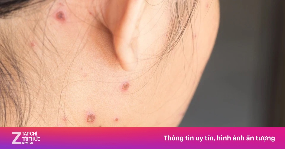 Đã từng mắc thủy đậu có cần tiêm vaccine?