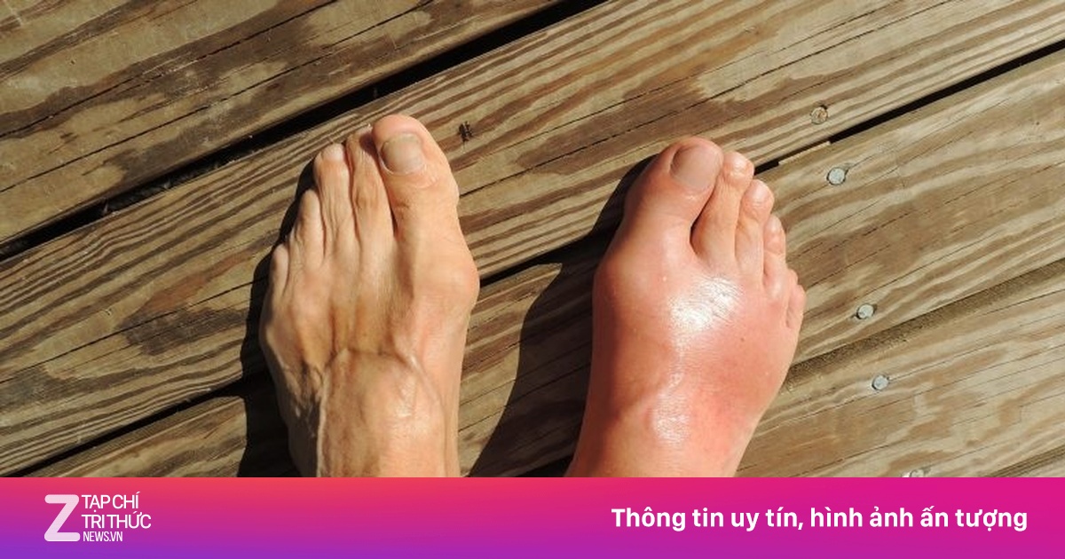 7 yếu tố làm tăng nguy cơ mắc bệnh gout