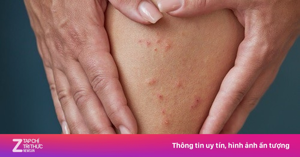 Dấu hiệu chứng tỏ bạn đang bị ghẻ