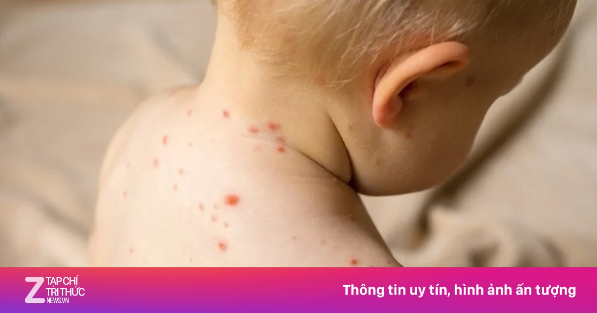 Điều tuyệt đối nên tránh khi bị sởi