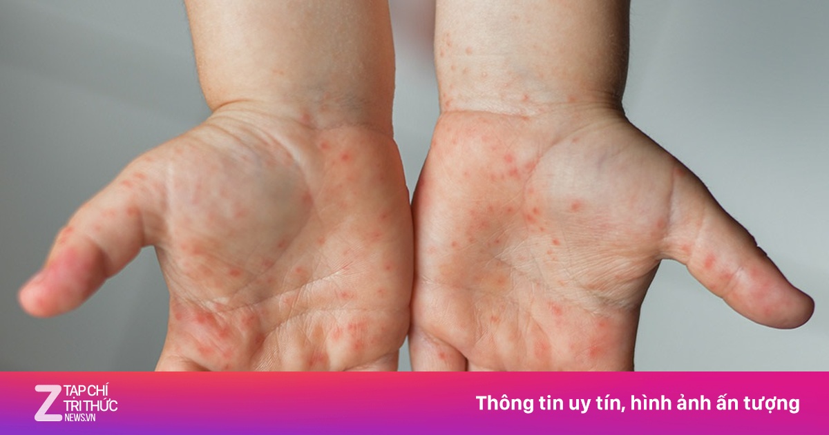 Biểu hiện trở nặng khi trẻ mắc tay chân miệng