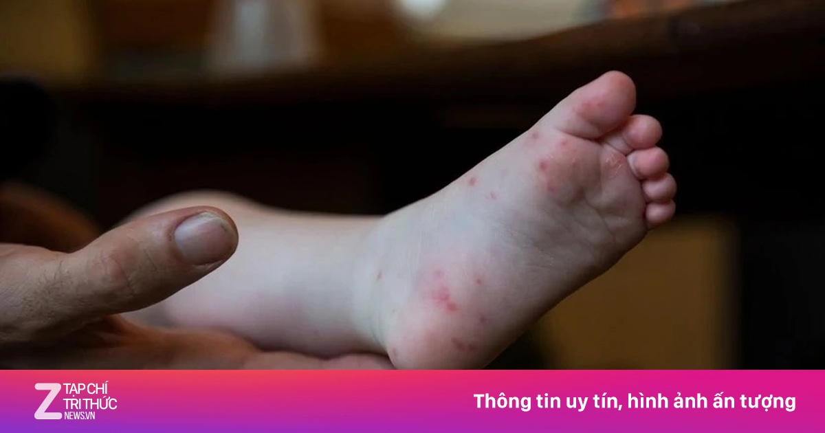 Thời điểm lây nhiễm cao nhất của bệnh tay chân miệng