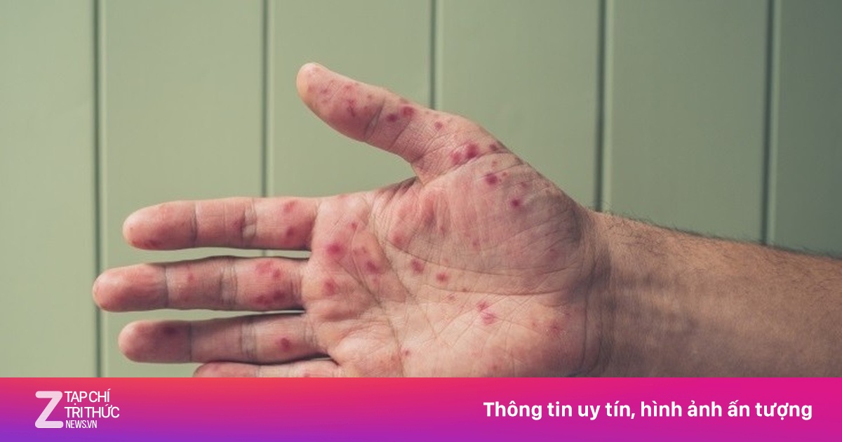 Loại virus đang lan 'vượt ngoài tầm kiểm soát', không có thuốc đặc trị