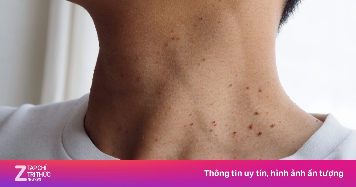 Thực phẩm khiến đường huyết tăng vọt 'không phanh' không kém đồ ngọt