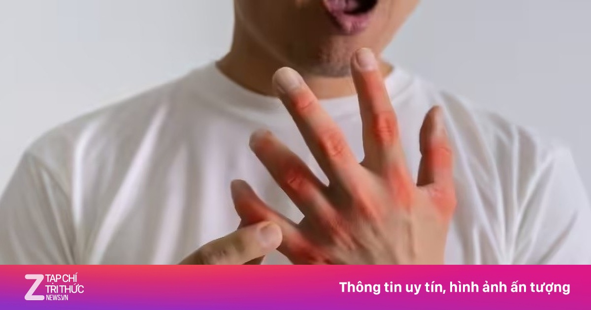 Dấu hiệu cảnh báo nồng độ axit uric tăng cao