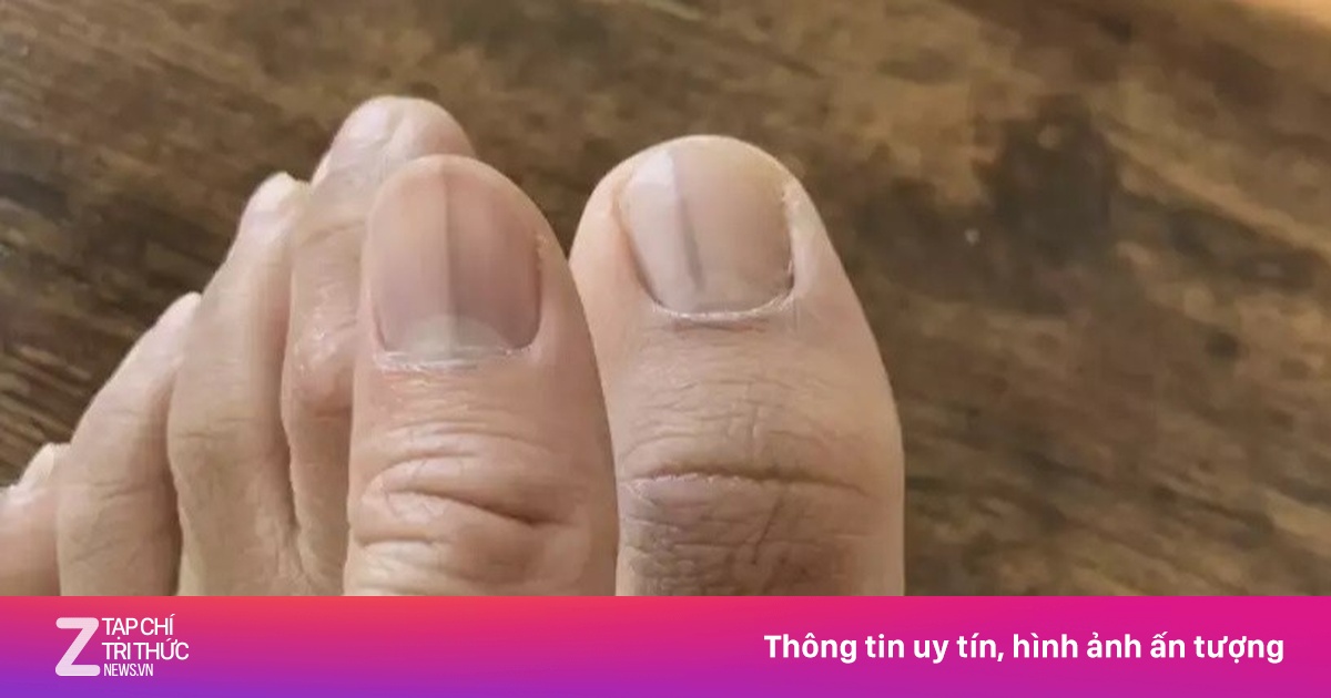 Dấu hiệu lạ trên móng chỉ báo mắc ung thư nguy hiểm
