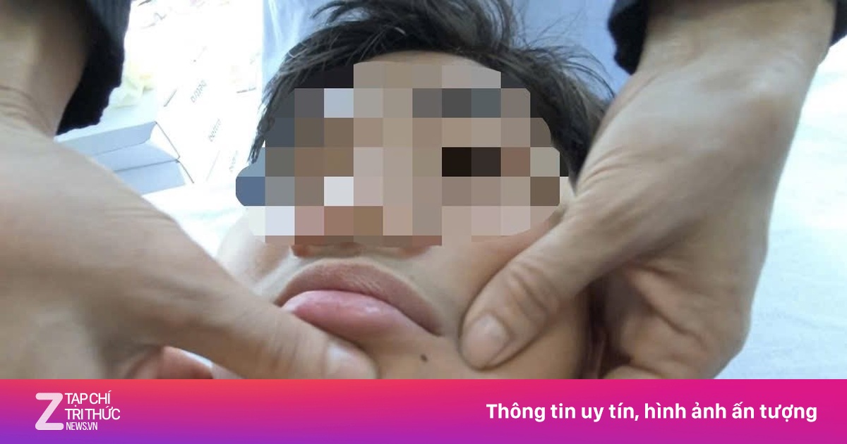 Nhiều người nhập viện vì méo miệng, mắt trái không nhắm kín