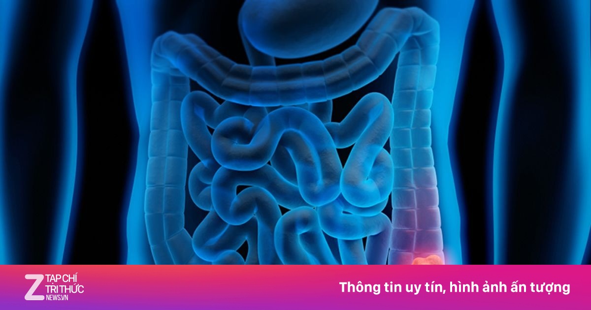 Thói quen 'tiếp tay' cho ung thư đại trực tràng, nguy cơ tới 90%