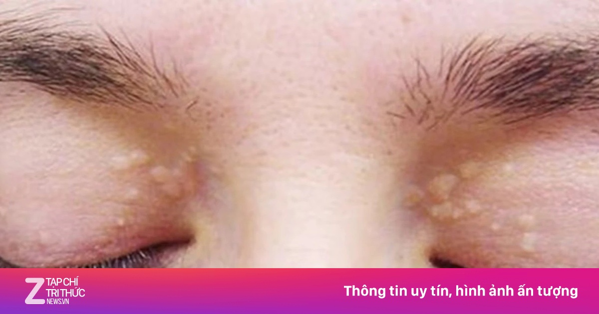 Triệu chứng mỡ máu ở mức nguy hiểm xuất hiện trên da