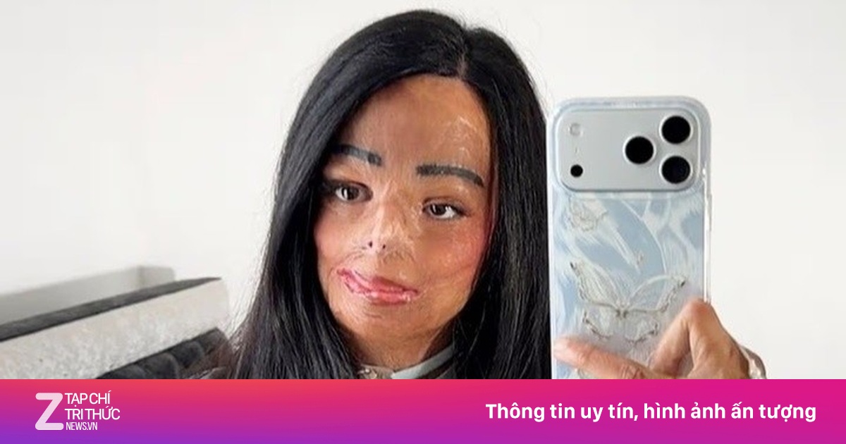 Dầu gội đầu bắt lửa, cô gái bị bỏng nửa người và mất 7 ngón tay