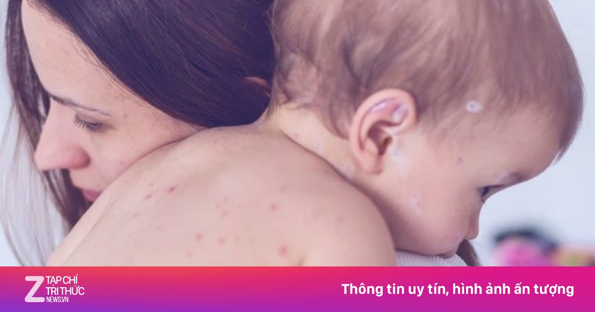 Trẻ Bị Thủy Đậu Nên Ăn Gì Để Nhanh Khỏi và Tránh Biến Chứng?