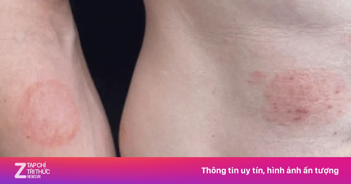 Một bệnh lây truyền qua đường tình dục đang lan rộng ở Mỹ