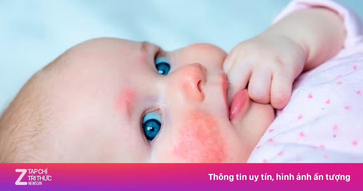 Dấu hiệu trẻ bị dị ứng đạm sữa bò