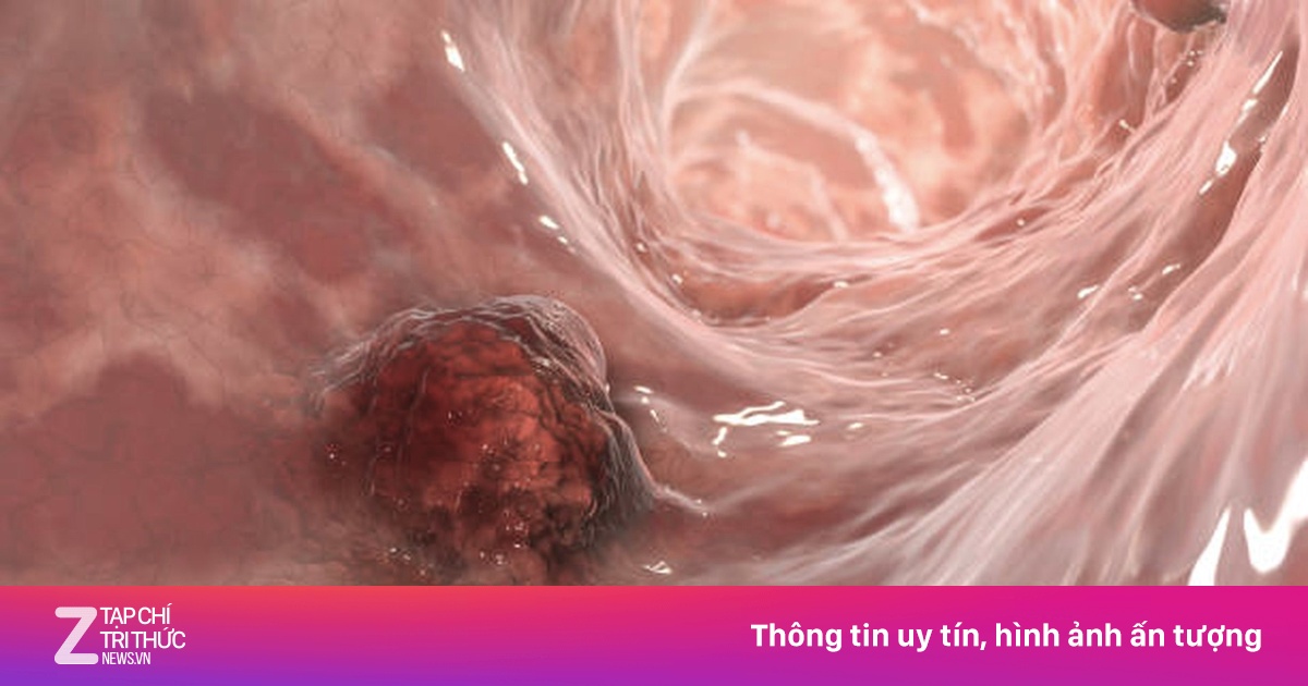 7 dấu hiệu âm thầm cảnh báo ung thư dạ dày