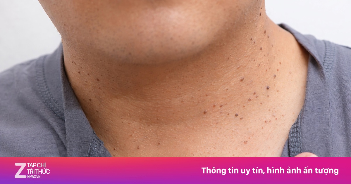 Kháng insulin dễ gặp ở người trẻ, gặp 5 dấu hiệu này cần đi khám sớm