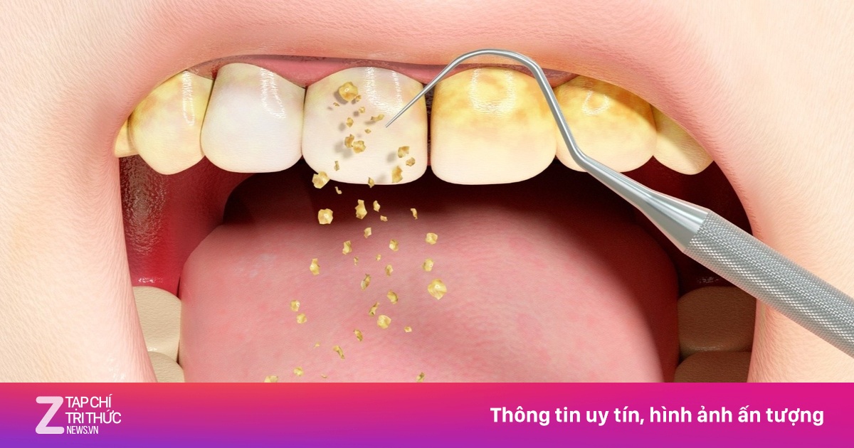Dấu hiệu đến lúc cần lấy cao răng