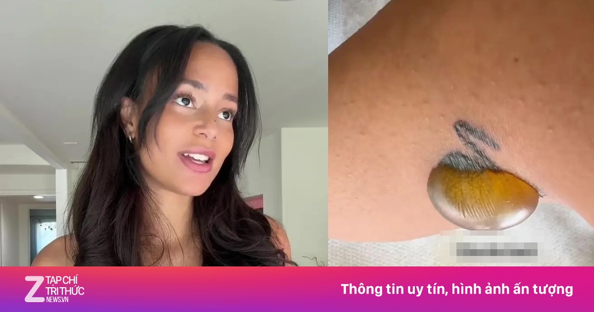 Nữ KOL Hoảng Sợ Kêu Cứu Sau Biến Chứng 'Kinh Tởm' Khi Xóa Hình Xăm