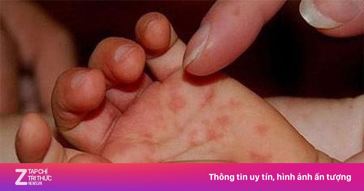 TP.HCM Tăng Cường Giám Sát Dịch Tay Chân Miệng Tại Phường Bình Hưng Hòa