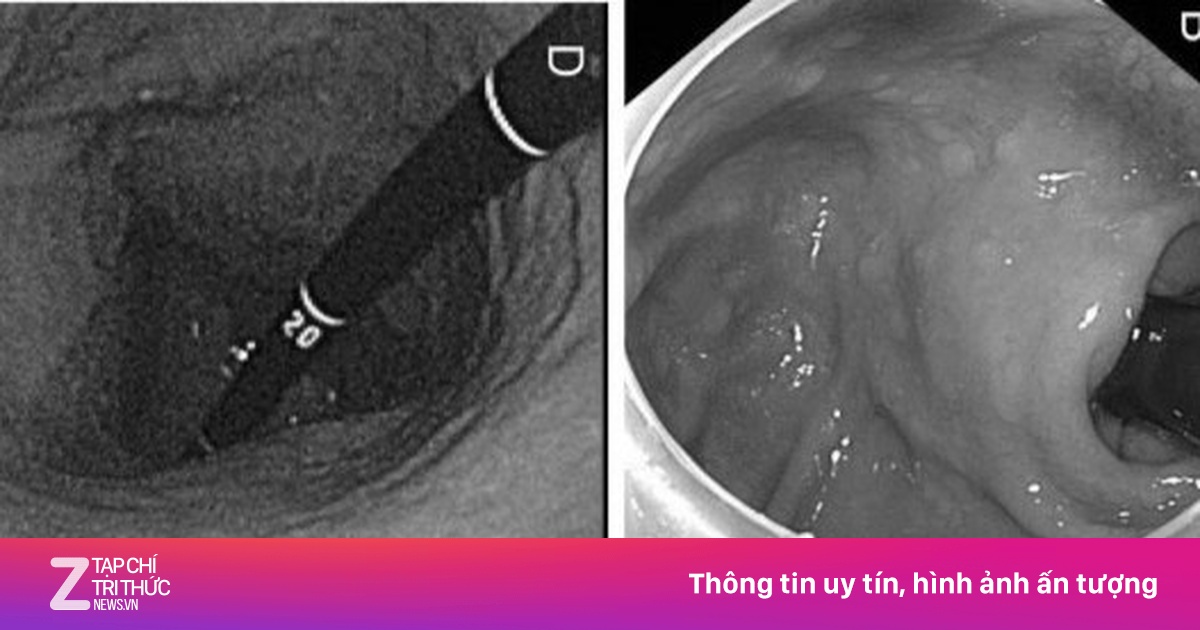 Những thói quen 'tiếp tay' cho ung thư dạ dày