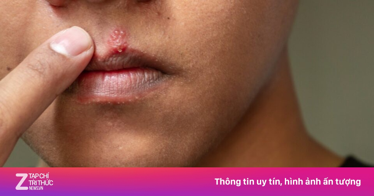 Thói quen âm thầm 'nuôi dưỡng' ung thư lưỡi