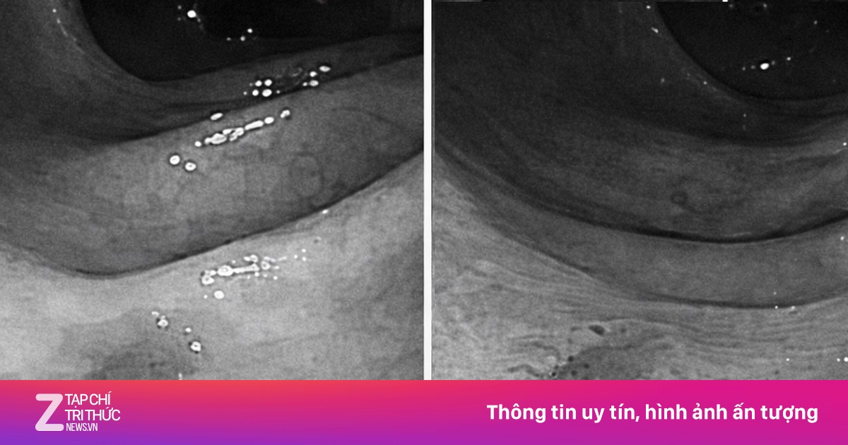 Bé trai 12 tuổi mắc ung thư đại tràng giai đoạn cuối do thói quen ăn uống thiếu lành mạnh