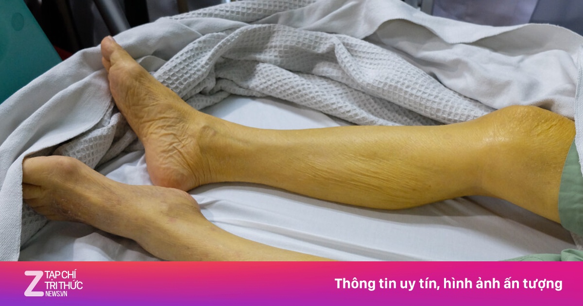 7 dấu hiệu hay gặp ở người mắc bệnh gan