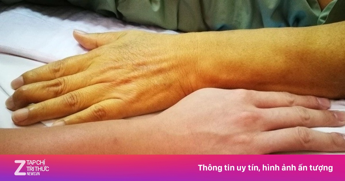 Gặp 6 dấu hiệu này thường xuyên, nên đi khám gan sớm