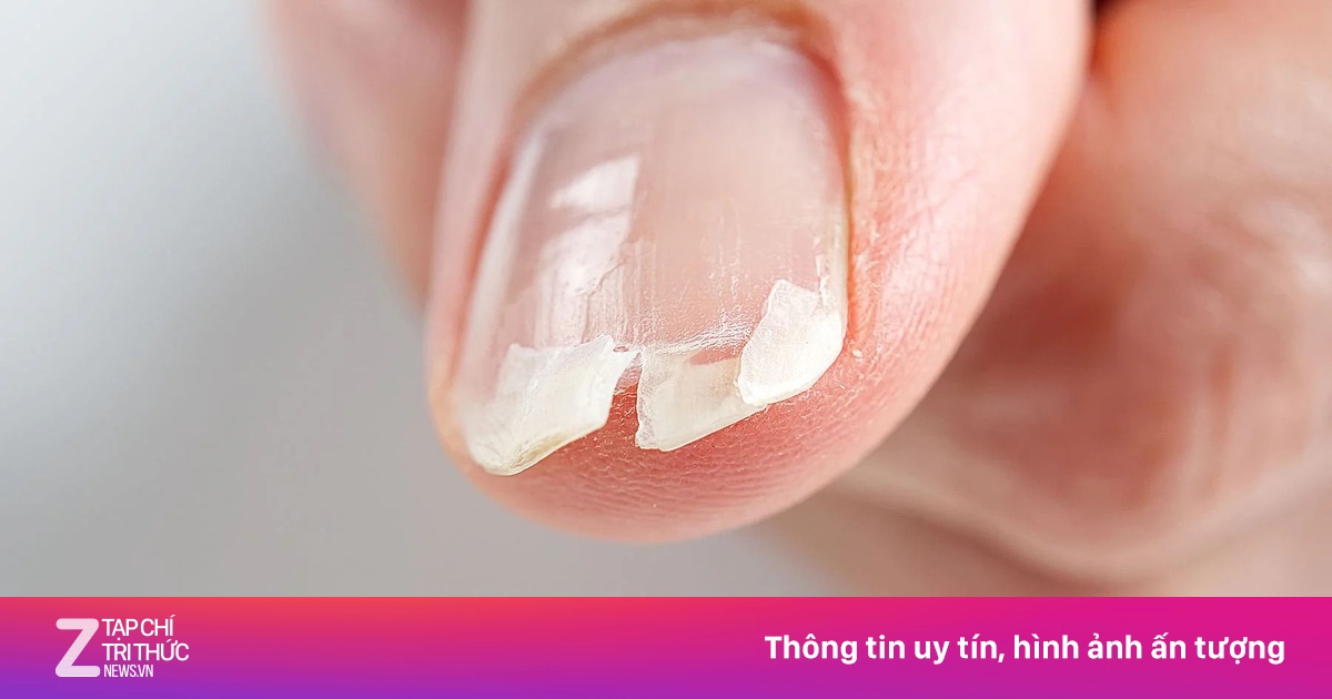 Bất thường ở móng tay cảnh báo bệnh gan, tiểu đường