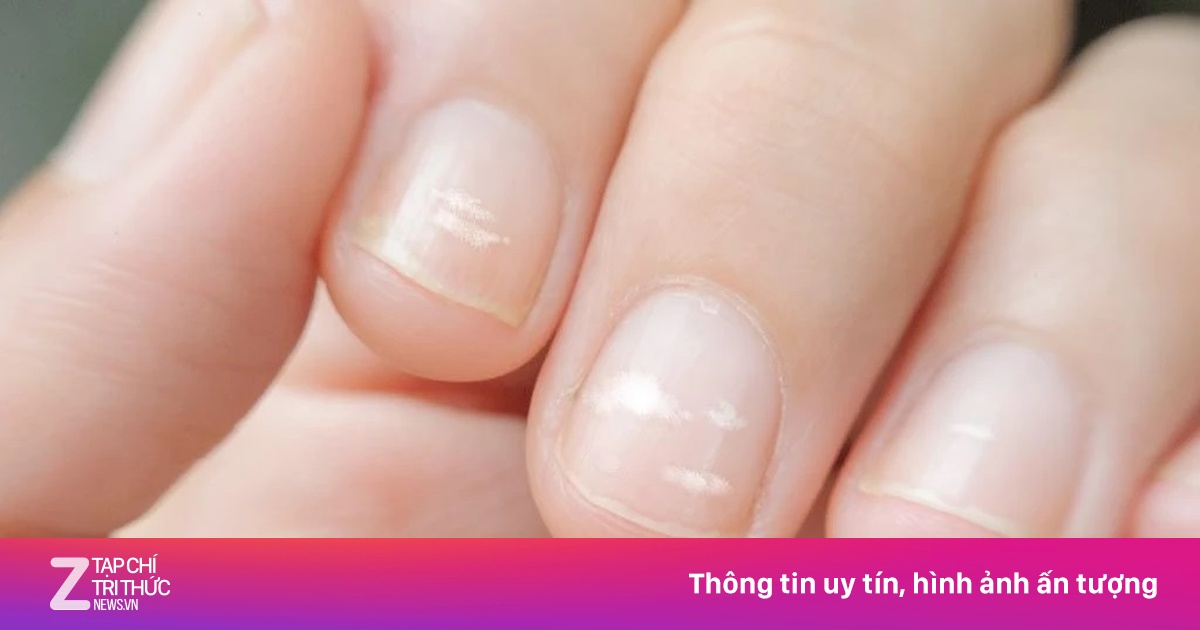 Nhìn móng tay biết bệnh? 6 dấu hiệu cảnh báo không nên bỏ qua
