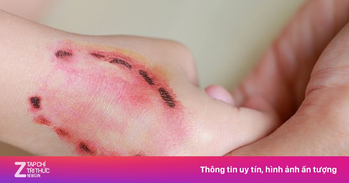 Giấu chuyện bị chó cắn, bé gái ra đi thương tâm sau 48 giờ phát dại