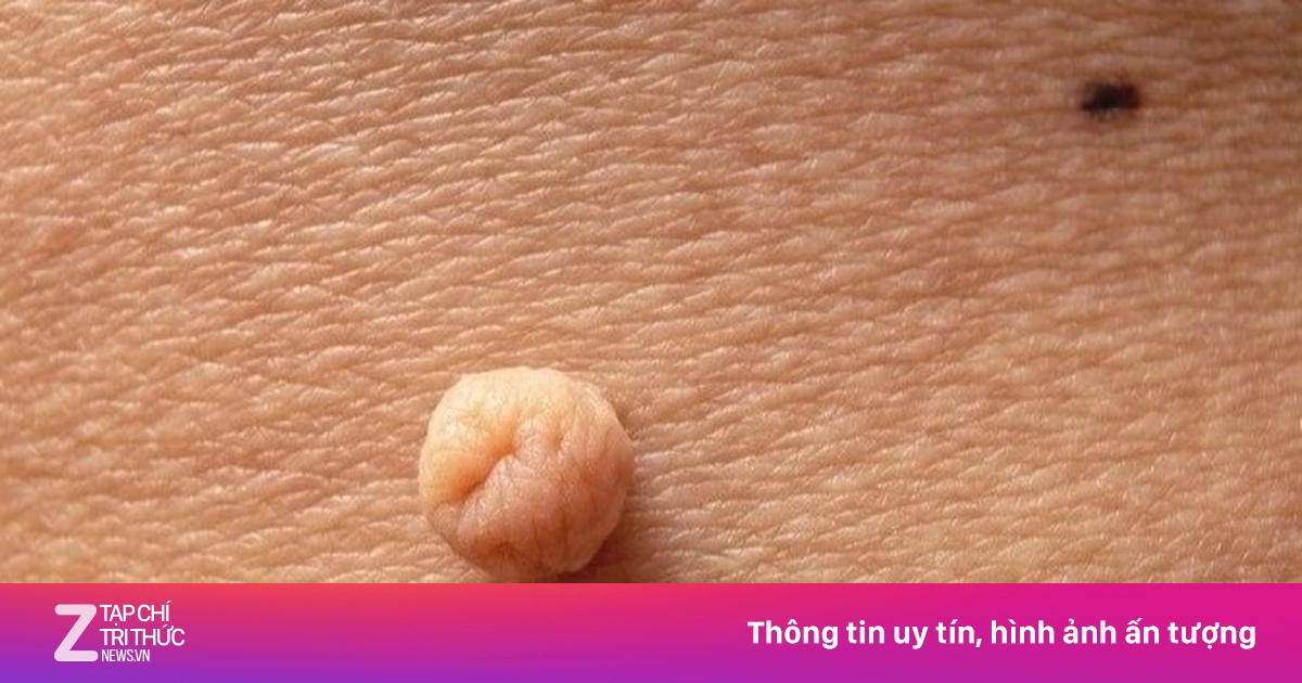 Sai lầm khiến người đàn ông có đến 103 nốt sùi mào gà
