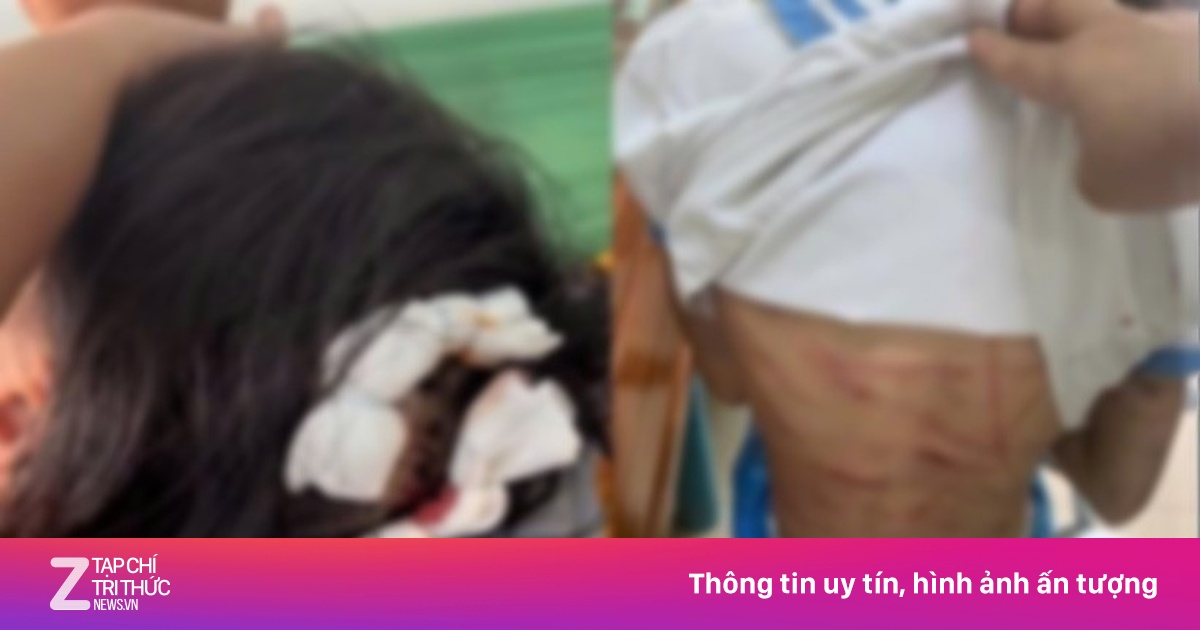 Tình trạng sức khỏe bé 9 tuổi bị cha dượng dùng búa đinh đánh vào đầu