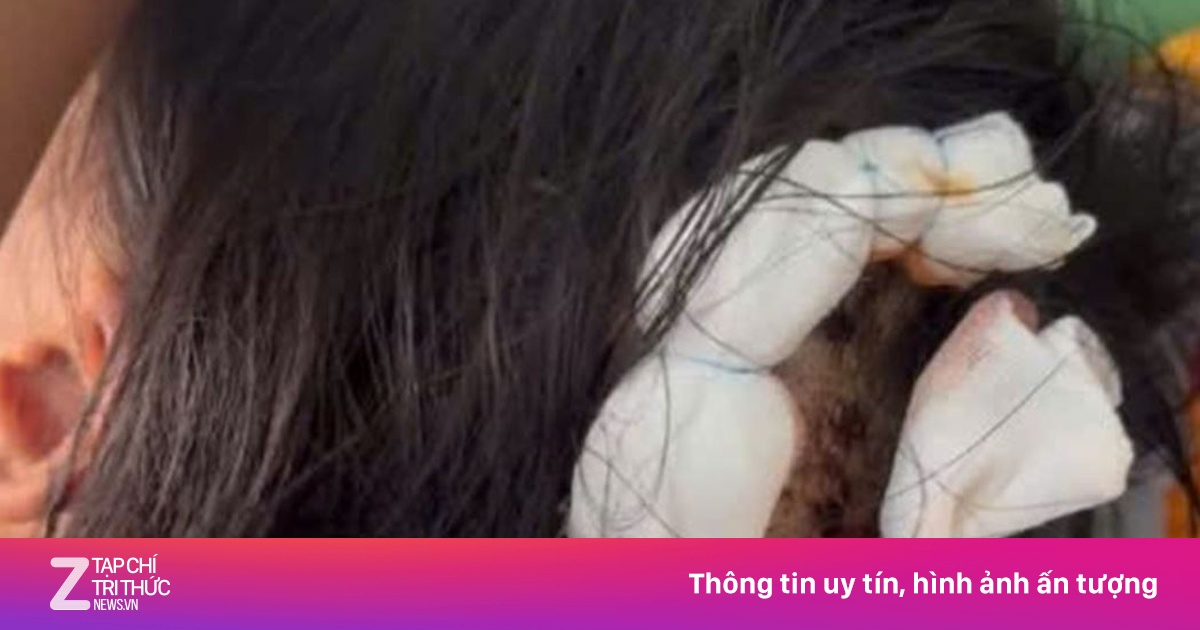 Tình tiết mới vụ bé gái lớp 5 bị cha dượng bạo hành dã man