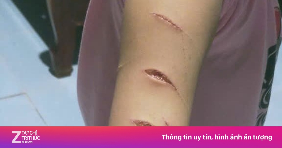 Công an Cà Mau xử lý vụ nữ sinh lớp 5 bị chị họ dùng dao rạch tay