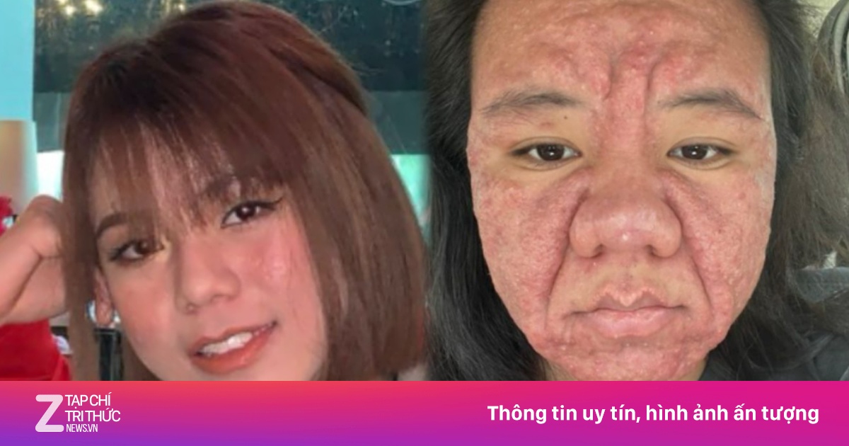 Sốc với gương mặt biến đổi khi mang thai của bà mẹ Malaysia