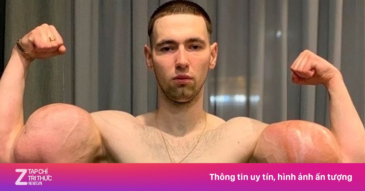 'Quái vật phòng gym' Nga trả giá đắt vì cặp bắp tay 61 cm