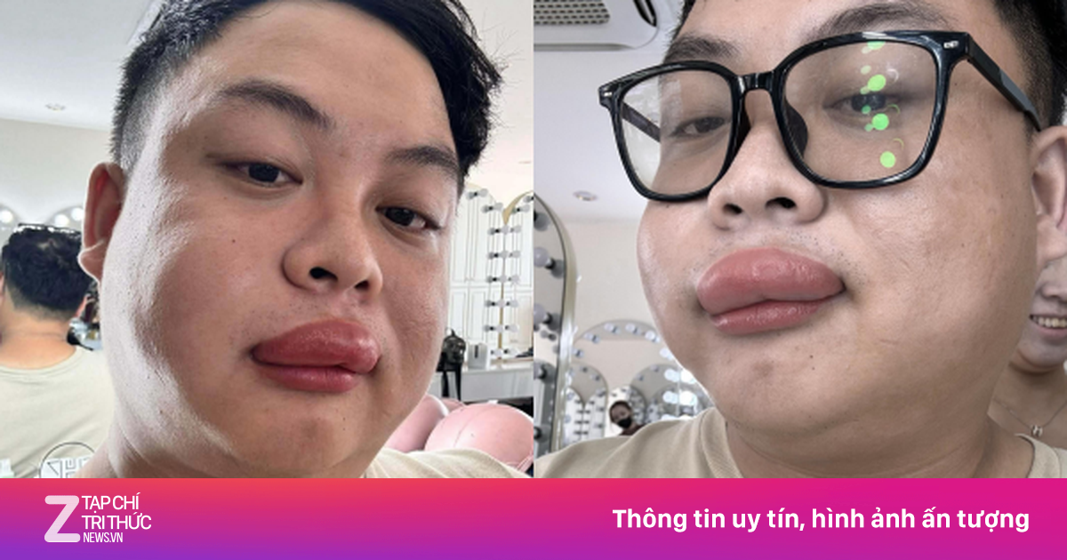 Thợ Trang Điểm Và Cô Dâu Vĩnh Long Bị Ong Chích Sưng Vù Mặt Trong Ngày Cưới