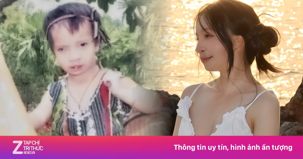 Cô gái bị hở hàm ếch khiến dân mạng cảm phục vì nghị lực phi thường