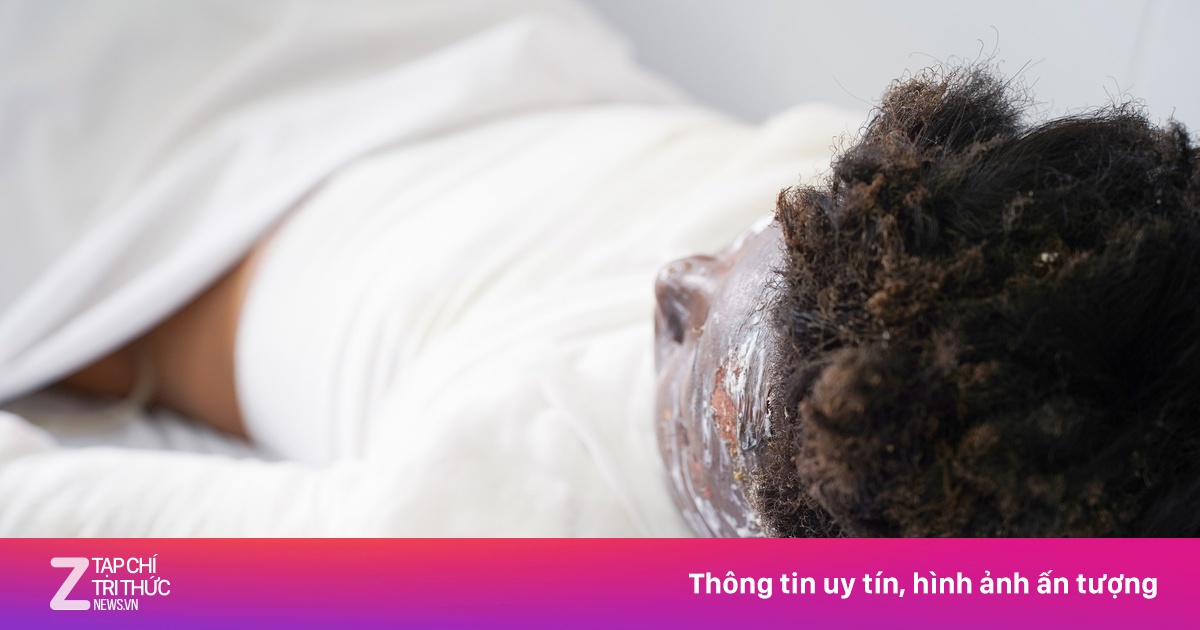 Trò vui khiến bé trai bỏng thương tâm toàn bộ mặt