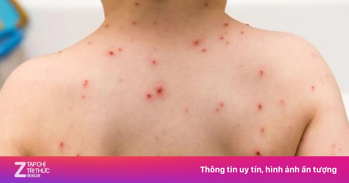 Bệnh sởi có thể bị mấy lần trong đời, làm sao để phòng ngừa?