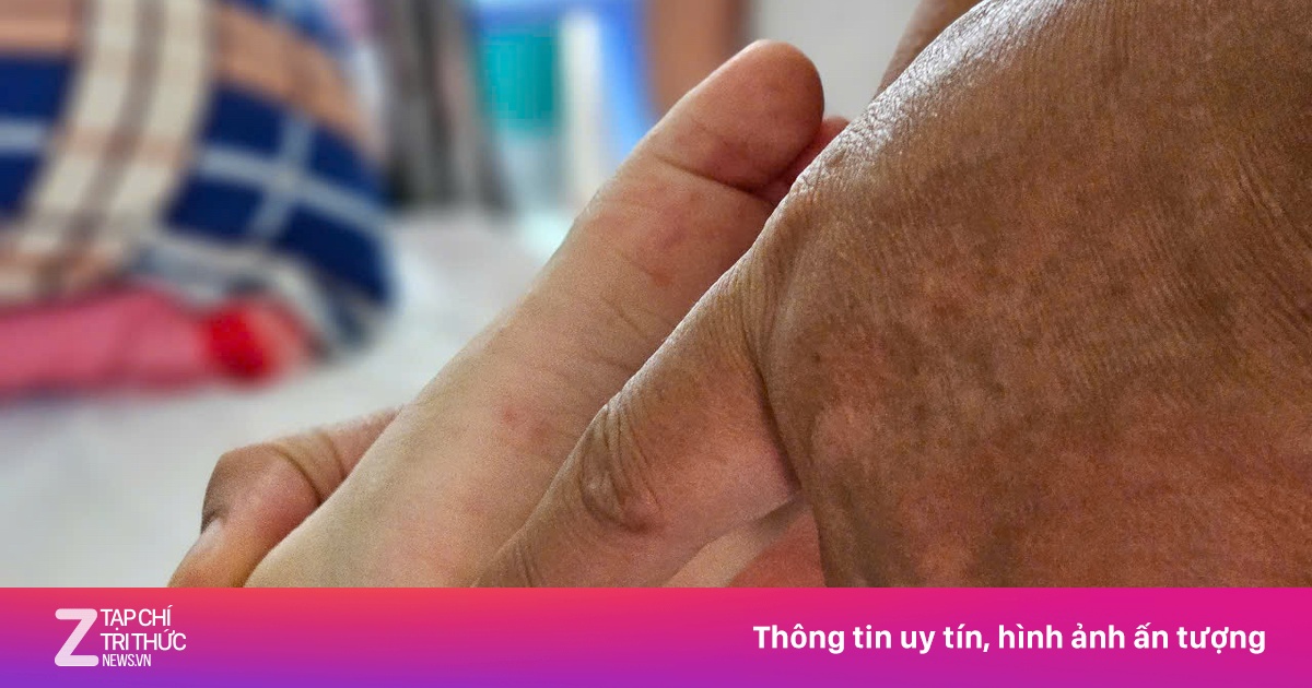 Tay chân miệng vào mùa, phụ huynh cần làm gì để bảo vệ con?