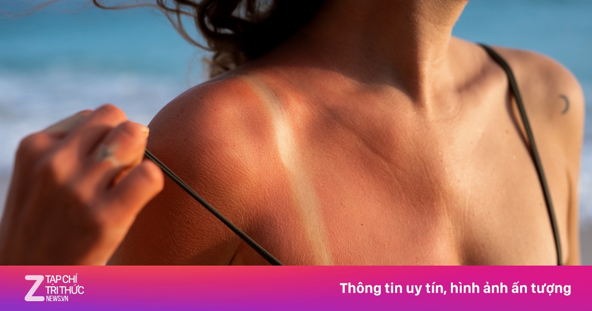'Cấp cứu' làn da cháy nắng