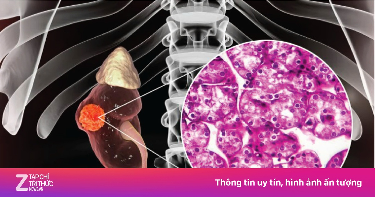 Nôn ói kéo dài, người phụ nữ không ngờ mắc ung thư thận