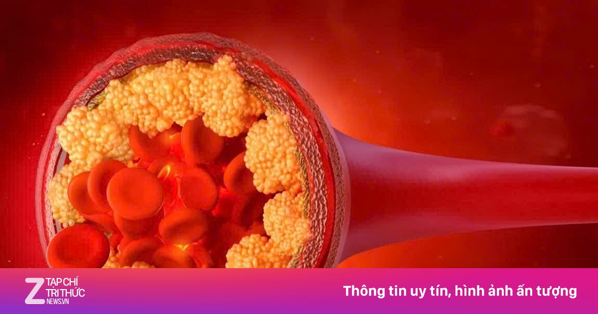 Ai nên tầm soát mỡ máu?