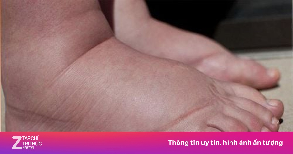 Dấu hiệu không ngờ khiến bé trai phát hiện bệnh thận