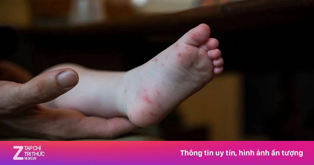 Hơn 9.000 ca tay chân miệng, TP.HCM cảnh báo nguy cơ bùng phát