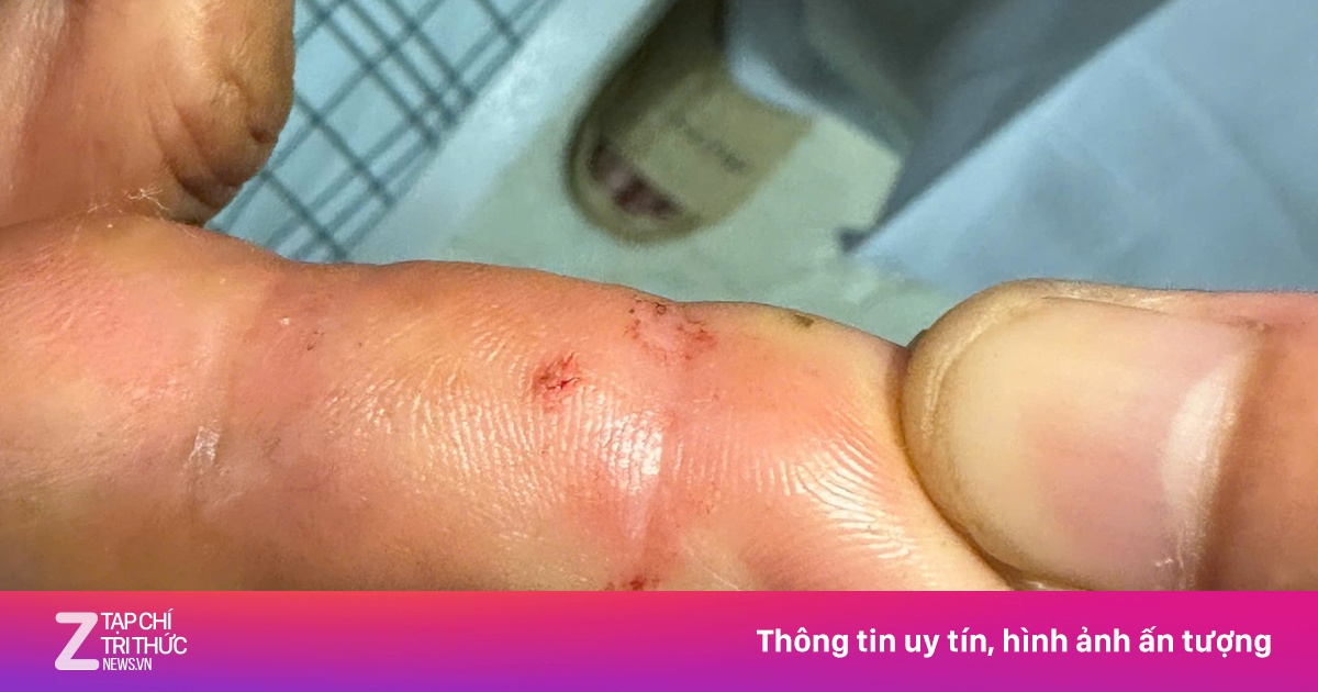 Thêm một người bị rắn hổ mang cắn