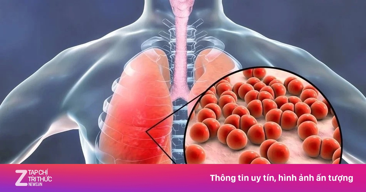 Cảnh báo phế cầu khuẩn gây viêm màng não, nhiễm trùng toàn thân