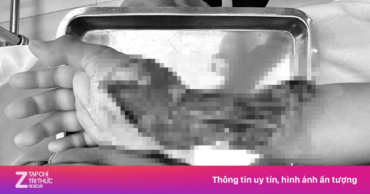 Trẻ 10 tuổi dập nát tay phải vì tường đổ sập
